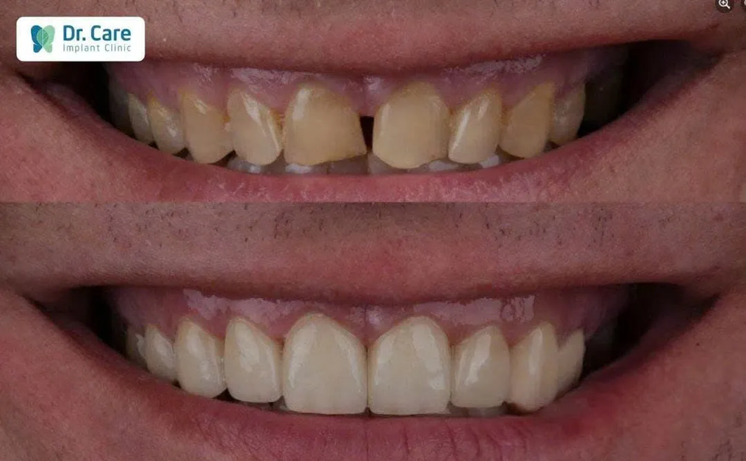 before and after image of a patient who was fitted with porcelain e.max veneers at doctor care implant clinic at ho chi mingh city in Vietnam, a popular medical travel destination in 2026