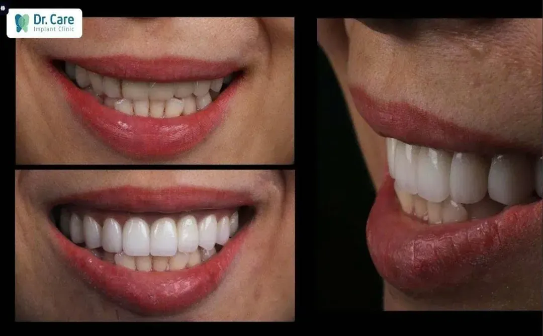 before and after image of a patient who was fitted with porcelain e.max veneers at doctor care implant clinic at ho chi mingh city in Vietnam, a popular medical travel destination in 2026