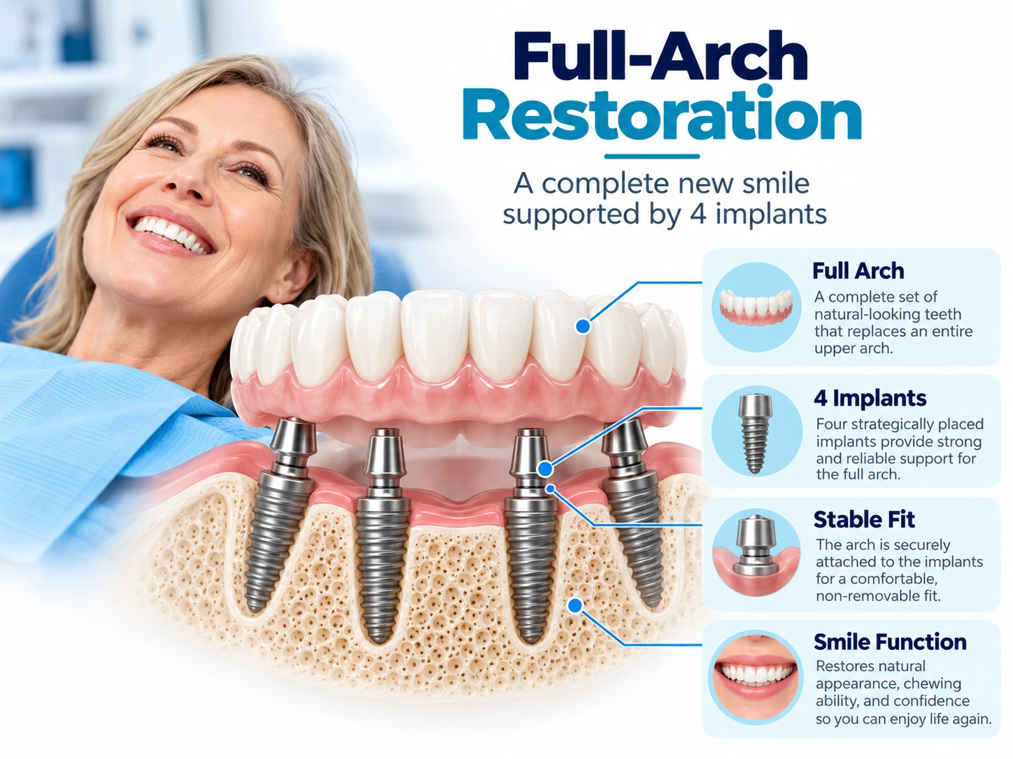 Full-arch dental implants in Vietnam with fixed restoration supported by four implants